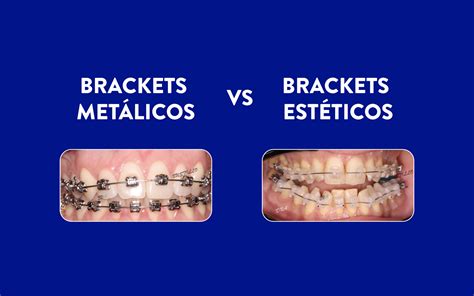 brackets transparentes vs metalicos|Brackets estéticos vs metálicos: ¿Cuál es la mejor .